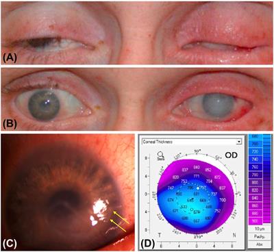 Vision health perspectives on Breaking Bad: Ophthalmic sequelae of methamphetamine use disorder